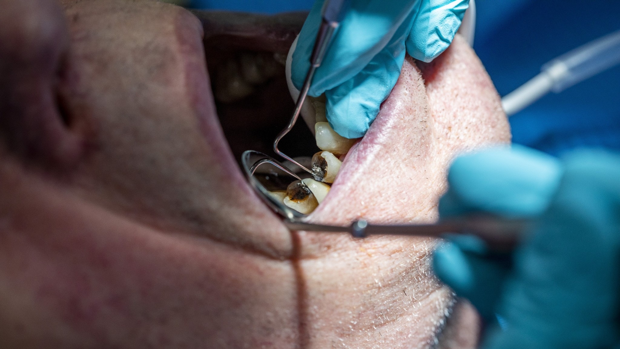 Organised crime target dental care insurance to defraud the system