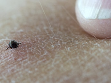Record number of TBE cases — but tick season's not over yet
