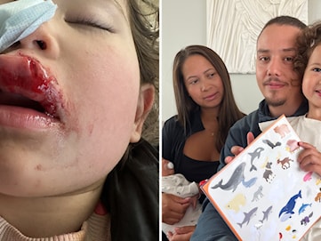3-åriga Linnea blev biten av en hund